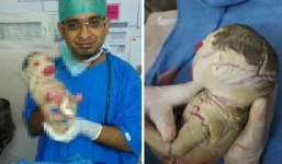 Xót xa bé sơ sinh mắc chứng bệnh lạ